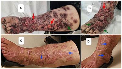 Chromoblastomycosis caused by Alternaria infectoria, concurrent with myiasis, in a recipient of a kidney transplant: a compelling case report